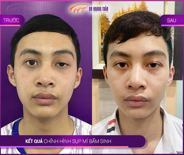 Kết quả sửa sụp mí tại Thẩm mỹ Hoàng Tuấn